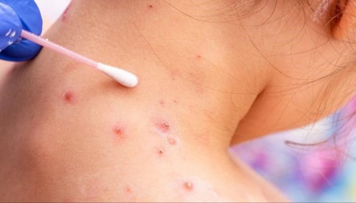 جدري القرود يفزع العالم بـ 80 إصابة جديدة