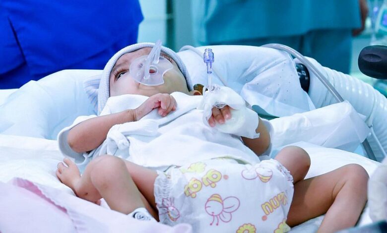 فصل التوائم السيامية